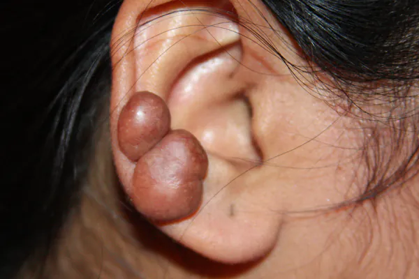 Closeup of an ear with two large piercing keloids located next to each other on the ear cartilage