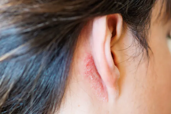 An ear with a red rash behind it
