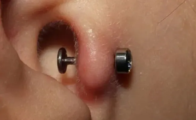 A swollen tragus piercing, adorned with a labret
