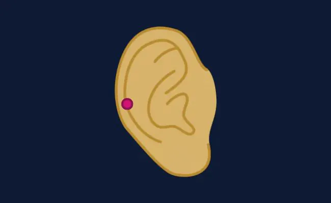 Illustration of an auricle piercing